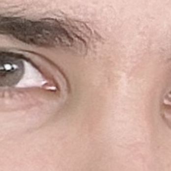 Gold Coast Aesthetics - Before filler - Medical Spas Near Me - Costa Mesa, California Gold Coast Aesthetics - Before filler - Medical Spas Near Me - Costa Mesa, California
