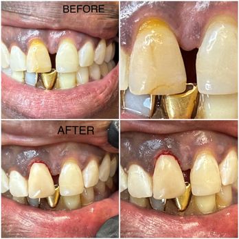 Dentistry For You - old composite filling, with cracks and change in color to a new composite filling. - General Dentistry Near Me - Phoenix, Arizona Dentistry For You - old composite filling, with cracks and change in color to a new composite filling. - General Dentistry Near Me - Phoenix, Arizona