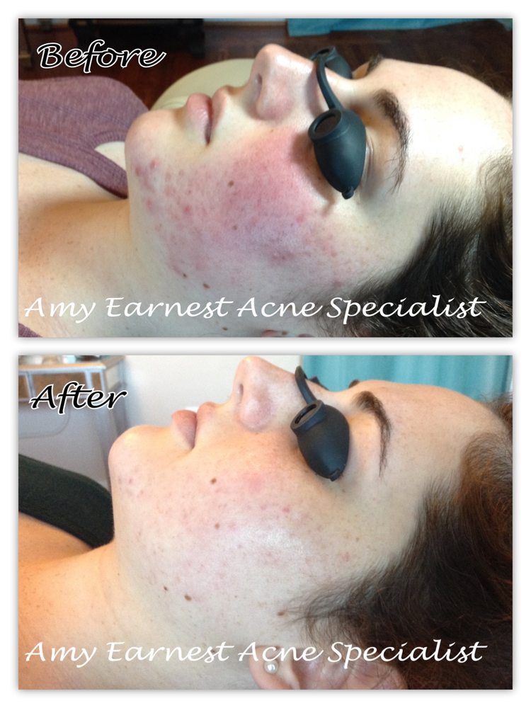 Amy Earnest Acne Specialist Logo