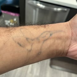 New Skin Tattoo Removal - Current progress