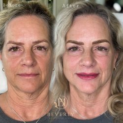 Beverly Microblading Center - Eyebrow Microblading and Lip Blush Cover up old tattoo  (before is not our work) before|After  done by Master Artist Farah Bahaelou