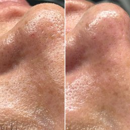 Cleaned out blackheads Cleaned out blackheads