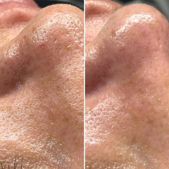 Evolution Skyn Aesthetics - Cleaned out blackheads - Skin Care Near Me - Riverside, California Evolution Skyn Aesthetics - Cleaned out blackheads - Skin Care Near Me - Riverside, California