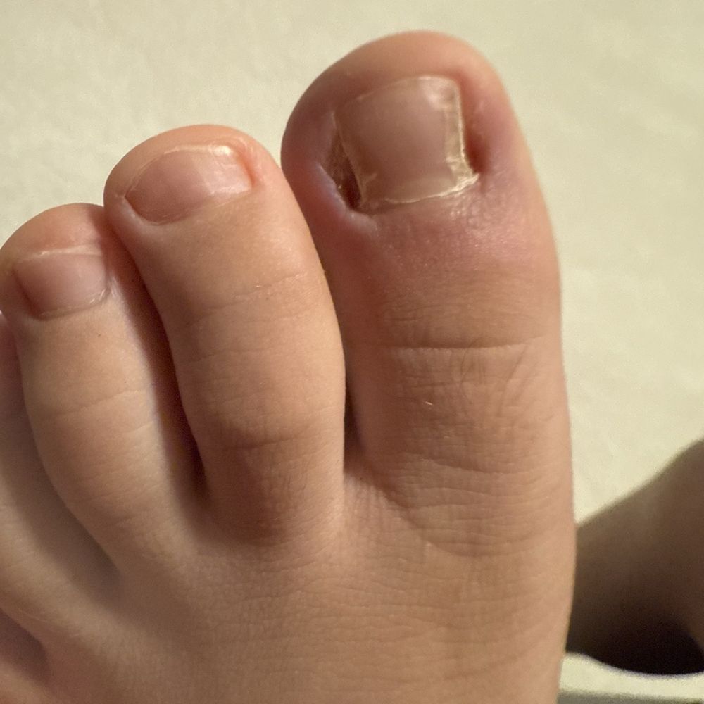 Stewart Foot And Ankle - After a couple of weeks - Podiatrists Near Me - Olympia, Washington Stewart Foot And Ankle - After a couple of weeks - Podiatrists Near Me - Olympia, Washington