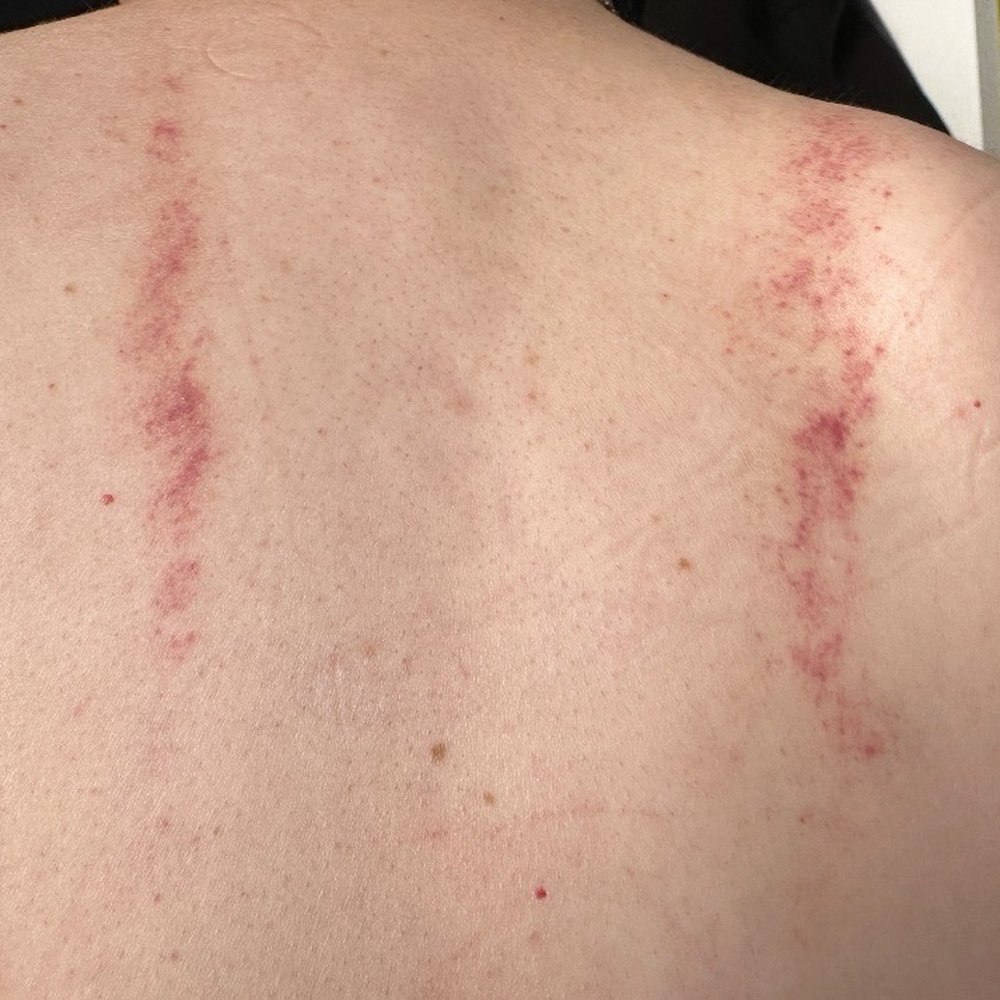 My back, the day after a "medium pressure" massage
