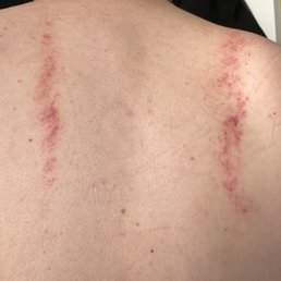 My back, the day after a "medium pressure" massage My back, the day after a "medium pressure" massage
