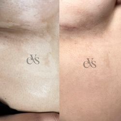 Elevate You Studio - White birthmark camouflage tattoo