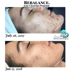 Augusta Sweet Sacred Skincareapy - Bye bye acne! I love being an Acne Specialist and helping dedicated clients achieve clear skin without nasty medications.