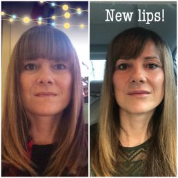 Lips before and after! Lips before and after!