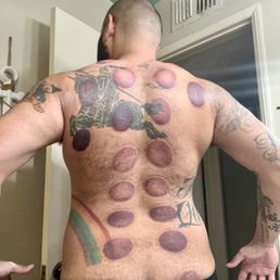 Cupping Cupping