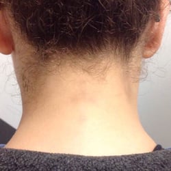 Removery Tattoo Removal & Fading - After treatments