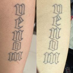 New Skin Tattoo Removal - after 2 sessions