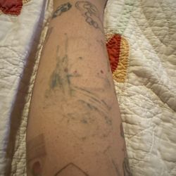 Removery Tattoo Removal & Fading - 8 sessions it was very heavy black so I'm happy with the results