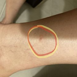 Brazilian Waxing By Sisters - Rash from improper hair wax removal.