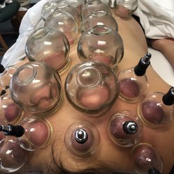 Insight Health Center - Cupping may look terrible during & after but the results are amazing