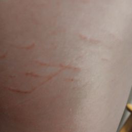 Injury sustained at this hotel Injury sustained at this hotel
