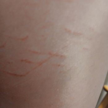 Hampton Inn Danville - Injury sustained at this hotel - Hotels Near Me - Danville, Kentucky Hampton Inn Danville - Injury sustained at this hotel - Hotels Near Me - Danville, Kentucky
