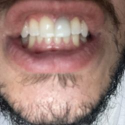 Glendale Premier Dental Center - Great job with my crown replacement