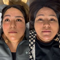 Acupuncture & Integrative Medical Center - AIMCDFW Irving Texas Bell's Palsy Experts. Recent patient, natural treatment with herbs and acupuncture, no surgery or drugs needed.