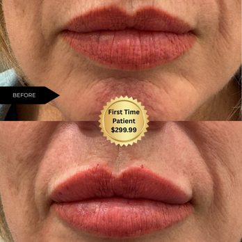 Aterna Wellness - Get the lips you've always wanted! Get Lip Filler in Fontana, CA just $299.99 at Aterna Wellness. Book now! - IV Hydration Near Me - Fontana, California