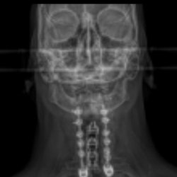 Center for Spine & Orthopedics - X-ray of infected hardware