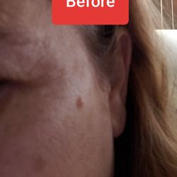 You can see that the hidrocystoma is significantly raised and quite noticeable.