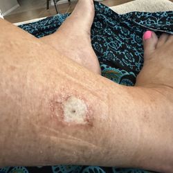 Skin and Cancer Institute - Sun City West - After the biopsy scraping. Infection already showing.