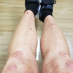 Chinese Acupuncture Massage Herb Clinic - November 2019. six month after my last acupuncture treatment. My psoriasis flare-up is gone. My skin is clear.