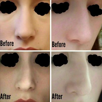 Partington Plastic Surgery and Laser Center - Rhinoplasty before & after - Plastic Surgeons Near Me - Bellevue, Washington Partington Plastic Surgery and Laser Center - Rhinoplasty before & after - Plastic Surgeons Near Me - Bellevue, Washington