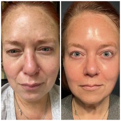 Rewind Skin Spa - Before and after photos