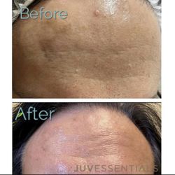 JuvEssentials - Microneedling for uneven skin tone and texture