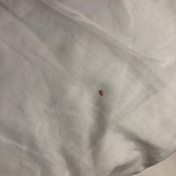 Hilton Garden Inn Amarillo - 3rd floor - blood stain from bed bugs on my pillow case. We were covered in bites. - Hotels Near Me - Amarillo, Texas Hilton Garden Inn Amarillo - 3rd floor - blood stain from bed bugs on my pillow case. We were covered in bites. - Hotels Near Me - Amarillo, Texas