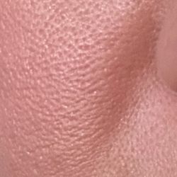 Sunrise Dermatology - After microneedling.