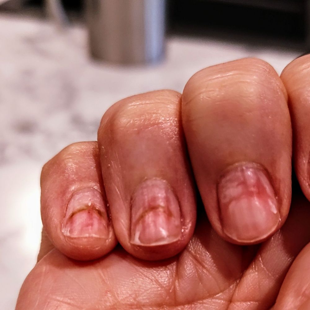 Share 135+ can nails stop growing ceg.edu.vn