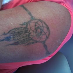 Louisville Tattoo Removal