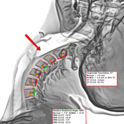 Digital Motion Xray - Auto "Accidents," Whiplash Injuries cause catastrophic failure of spinal ligaments resulting in spinal stenosis.