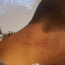 Great Clips - The scratch/cuts from the shears she used! Obviously saw what she did and KEPT GOING!
