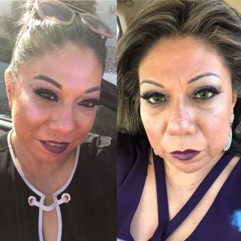 Chic la Vie Med Spa - Left is after treatment - Skin Care Near Me - Las Vegas, Nevada Chic la Vie Med Spa - Left is after treatment - Skin Care Near Me - Las Vegas, Nevada