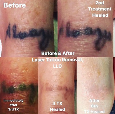 BEFORE & AFTER LASER TATTOO REMOVAL - Updated December 2024 - 13 Photos - 7049-A S Desert Blvd