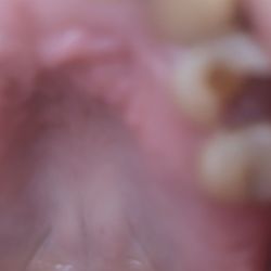 Dorothy Lane Dental - This is the tooth they drilled, filled, drilled, filled, then told me they damaged MY TEETH SO BAD I NEED A EXPENSIVE CROWN.