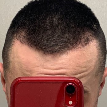 Jae Pak, M.D - Day before surgery - Hair Loss Centers Near Me - Los Angeles, California