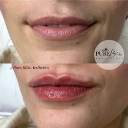 Pure Bliss Aesthetics - Before and after lip filler 0.5ml