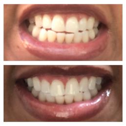 Before and after pictures of my teeth whitening session.