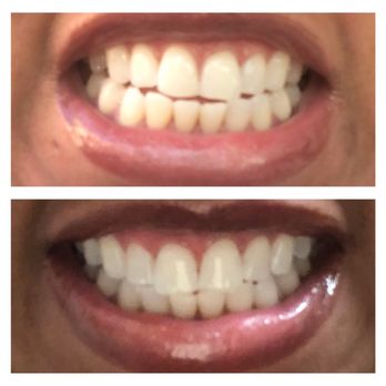 AZ Teeth Whitening Spa - Before and after pictures of my teeth whitening session. - Teeth Whitening Near Me - Phoenix, Arizona