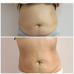 New Ro Aesthetics - Body Sculpting Transformation