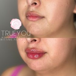 True You Medical Aesthetic - Lips by Nurse Kim