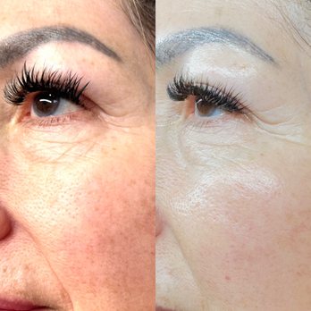 Renude Studio - Results after 3 Microchanneling treatments. Some fine lines around the eyes have disappeared and her complexion has improved & brightened. - Permanent Makeup Near Me - Glendale, California Renude Studio - Results after 3 Microchanneling treatments. Some fine lines around the eyes have disappeared and her complexion has improved & brightened. - Permanent Makeup Near Me - Glendale, California