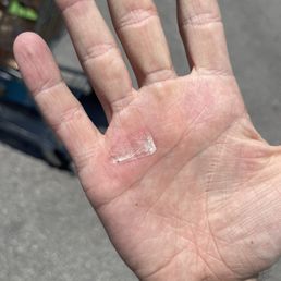 The burn immediately after it happened