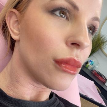Becky Does Botox - Fresh lips IMMEDIATELY after injections - Medical Spas Near Me - Channelview, Texas Becky Does Botox - Fresh lips IMMEDIATELY after injections - Medical Spas Near Me - Channelview, Texas