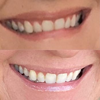 Layla Sophia Sunless Tanning - Teeth whitening after one studio visit with Layla Sophia.. - Spray Tanning Near Me - Salinas, California Layla Sophia Sunless Tanning - Teeth whitening after one studio visit with Layla Sophia.. - Spray Tanning Near Me - Salinas, California